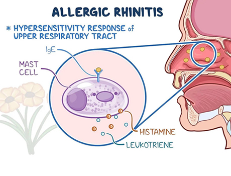 allergy 3