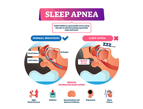 sleep-apnea