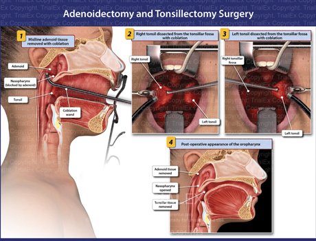 tonsillectomy and adenoidectomy