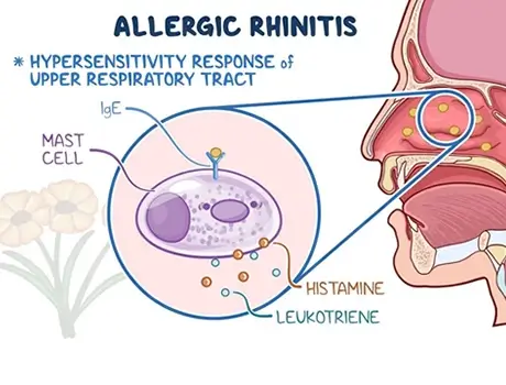 Allergy treatment