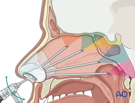 Skull Base Surgery