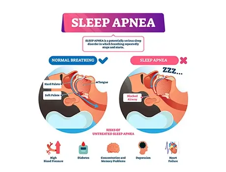 Sleep Apnea Treatment